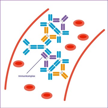 Abbildung Immunkomplex bei IgAN Abbildung Immunkomplex bei IgAN
