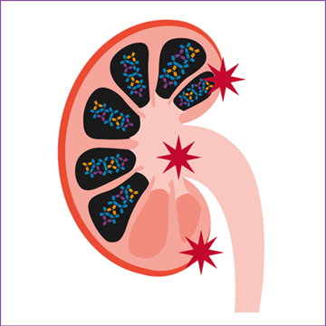 Abbildung einer Niere und den Risikofaktoren für terminale Niereninsuffizienz Abbildung einer Niere und den Risikofaktoren für terminale Niereninsuffizienz